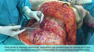 Reparación diastasis de rectos con abdominoplastia. Dr. Díaz Gutiérrez , cirujano plástico en Madrid