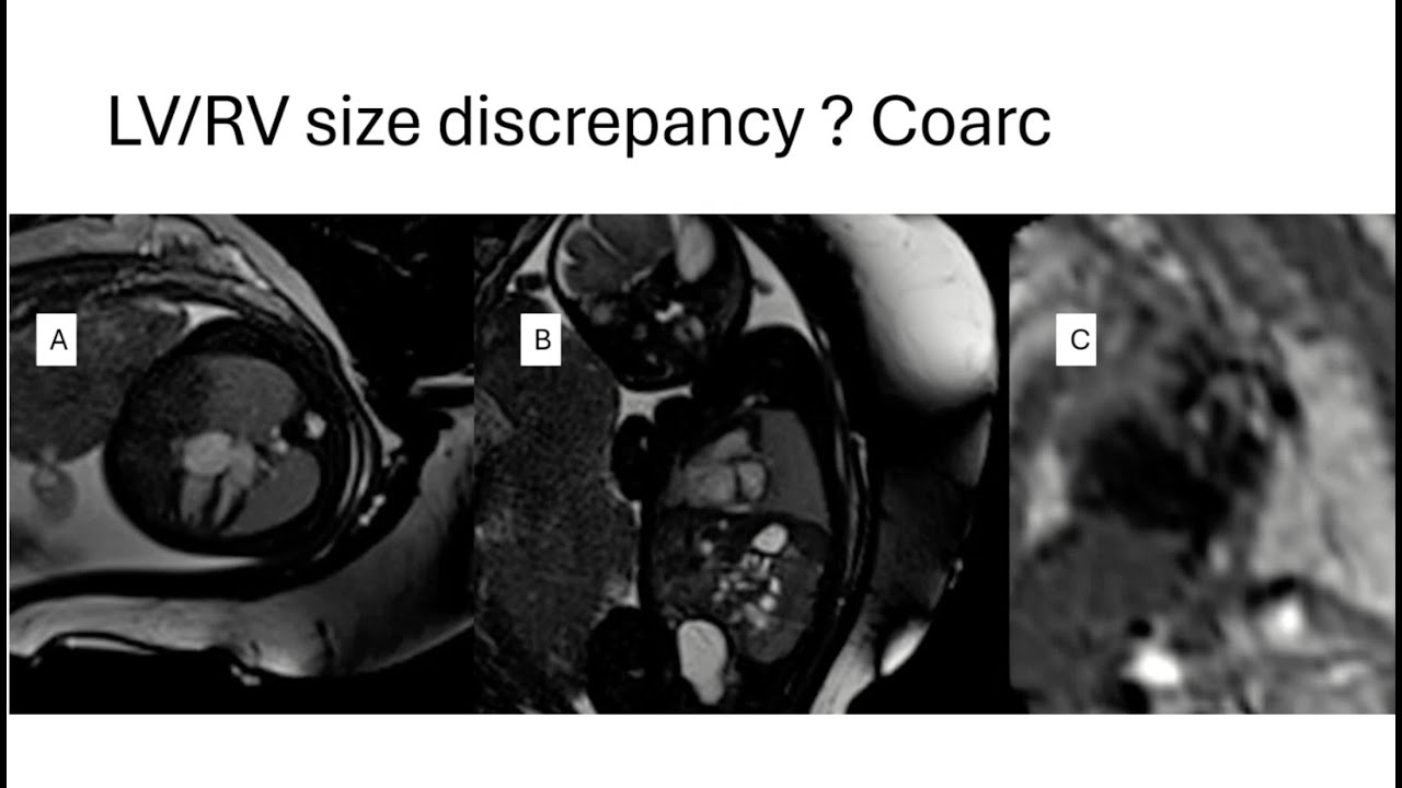 Webinar Winter Session 2025: Fetal Cardiac MRI - Practical Application and Clinical Case Insights