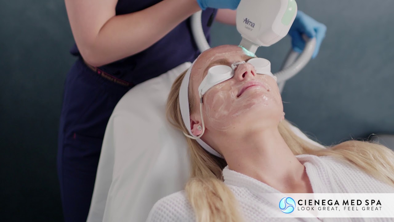 IPL Photofacial Treatment Video