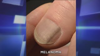 Subungual Melanoma: What You Need to Know
