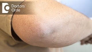 What causes pimple like spots above the elbow? - Dr. Rajdeep Mysore