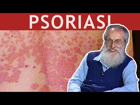 I rimedi di gente di eczema umidi diventanti Villaggio stroganovka Zaporizhia cura regionale di psoriasi