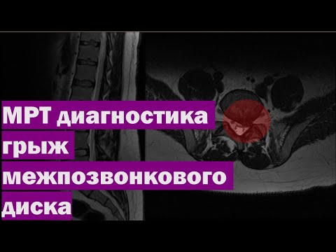 Боль в пояснице с иррадиацией по ходу мочеточника Болят суставы пальцев на руке что делать в домашних условиях