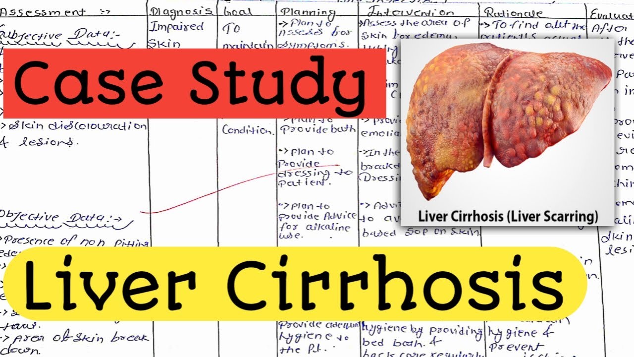 Case Study on Liver Cirrhosis || Case Presentation/ Nursing Care Plan #nursingcriteria