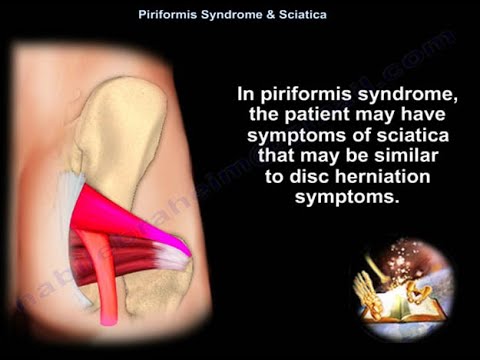 Syndrome du Piriforme et Sciatique - Dr Nabil Ebraheim