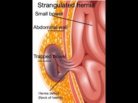 Strangulated hernia symptoms