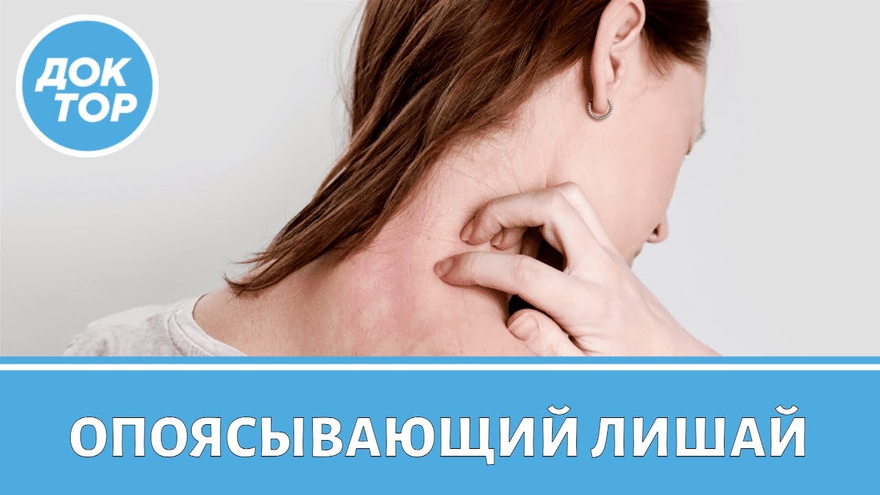 Как распознать опоясывающий лишай на ранней стадии