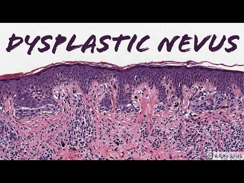Dysplastic Nevus: 5-Minute Pathology Pearls