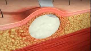 Skin Abscess I&D Animation. Injectioncourses.com