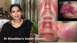 Rosacea Treatment in हिन्दी | How to get rid of face redness  | Skin sensitivity