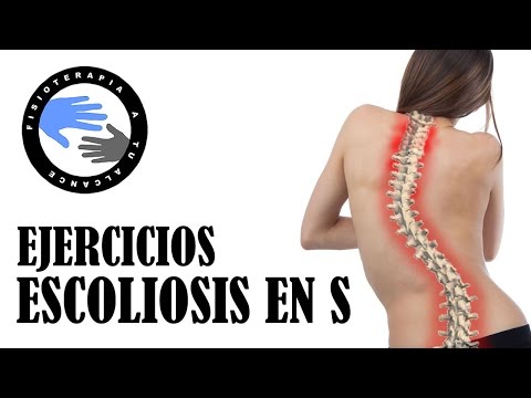 Escoliosis en S: ejercicios para aliviar el dolor y mejorar tu postura