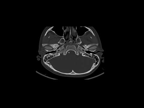 Agujeros de la Base de craneo y su contenido  Correlación Radiológica