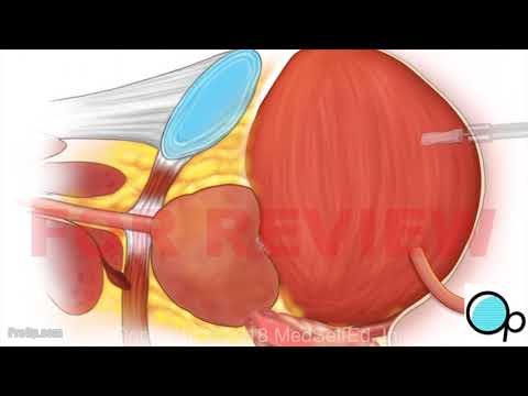 chirurgie prostatectomie și erecție