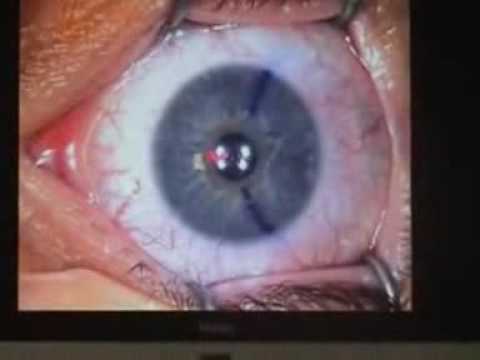 comment se faire rembourser une opération du nez