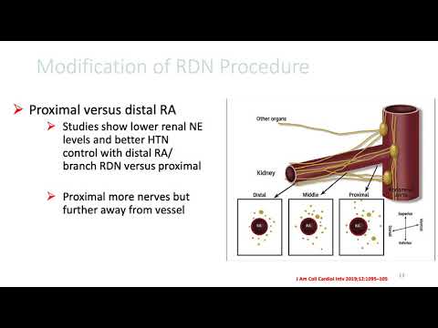 Renal denervation, is it really coming back?_Sundaram_Peripheral On Demand