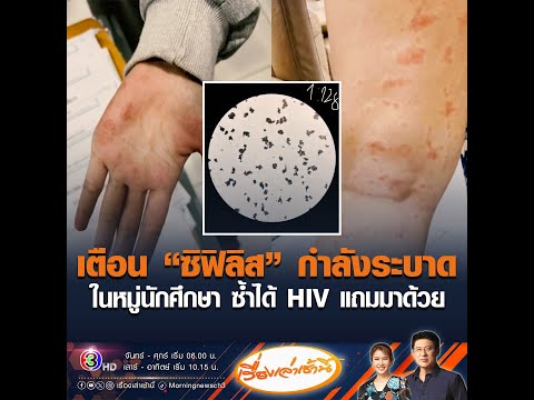 เตือน “ซิฟิลิส” กำลังระบาดในหมู่นักศึกษา ซ้ำได้ HIV แถมมาด้วย