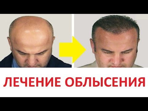 Opinie olej kokosowy do włosów Czy niska hemoglobina spadnie włos