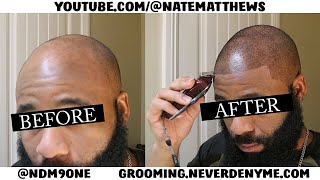 How To Get Your Hairline Back | From Bald To Edge Up | Hairline Restoration