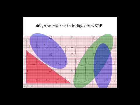 EKG Quiz    STEMI or Not