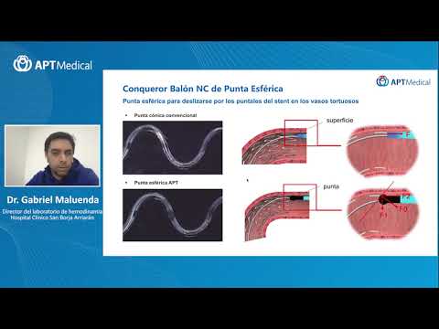 How to overcome a complex PCI case smoothly - SOLACI 2021