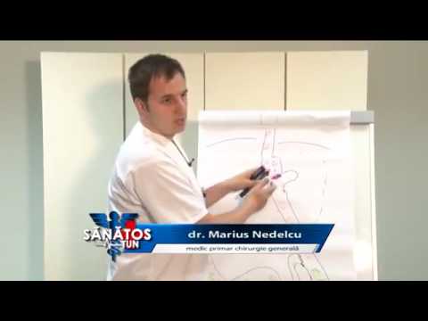 Sanatos Tun 25 august 2016   Dr  Marius Nedelcu   Bypass Gastric