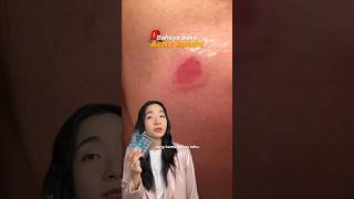Bahaya pake acne patch ! Yang kamu belum tau !