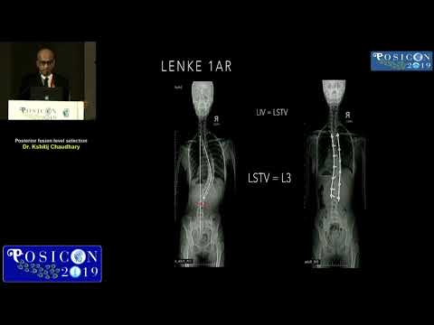 Selecting posterior fusion levels in Adolescent Idiopathic Scoliosis