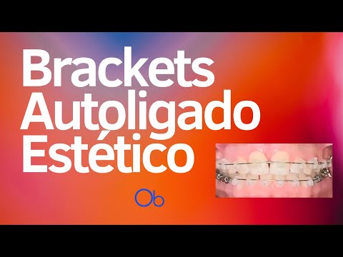 Brackets autoligado estéticos