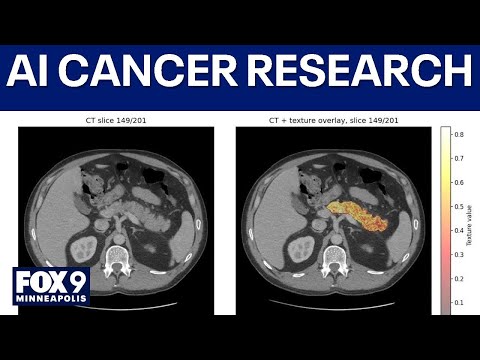 Mayo Clinic AI tool helps catch pancreatic cancer earl