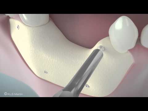 SonicWeld Rx® Dental – Shell technique for vertical defect augmentation