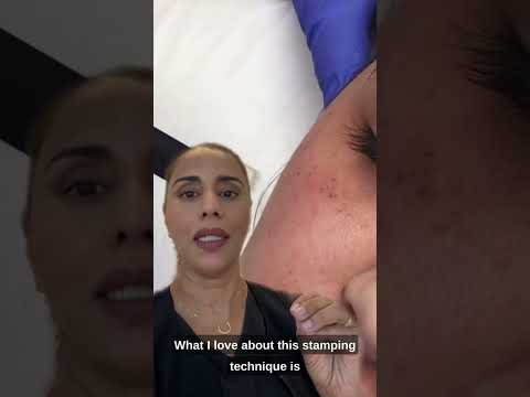 📲 Why ProCell is a much better alternative to micro-needling with pen devices