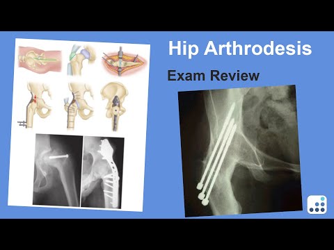 Hip Arthrodesis Exam Review - William Barrett, MD