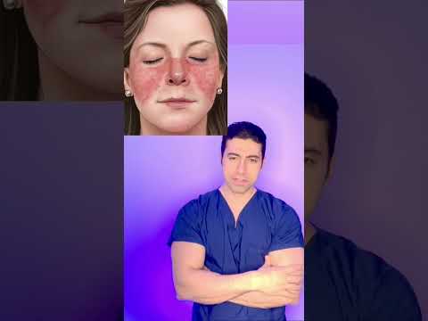 What is this butterfly face rash?