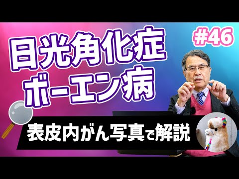 皮膚がん:暗闇でも太陽光は有害