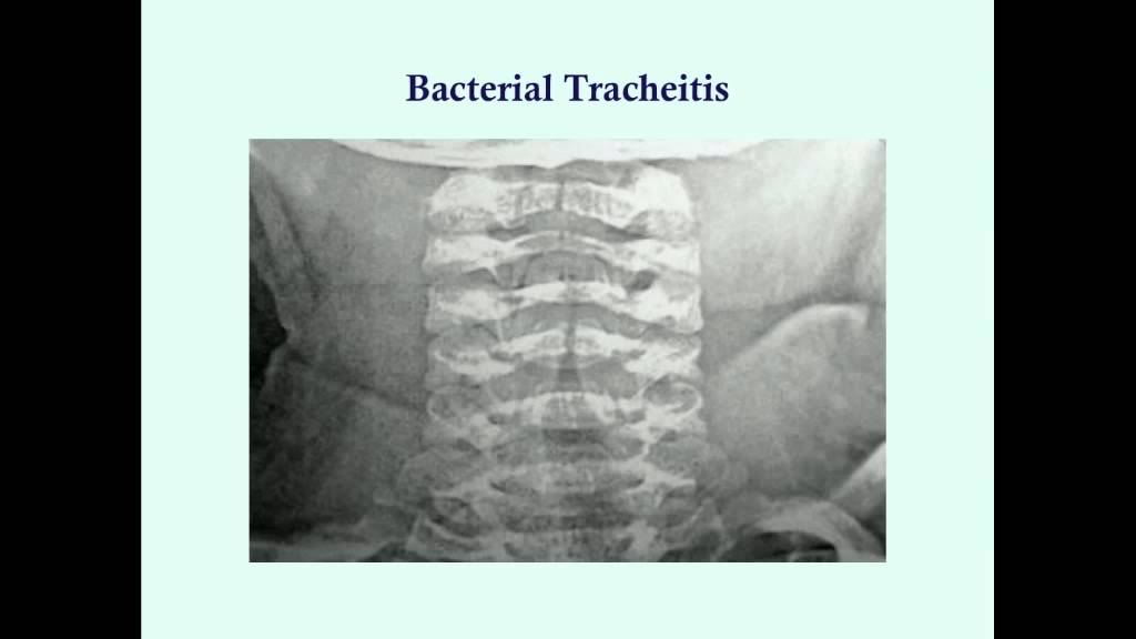 Bacterial Tracheitis - CRASH! Medical Review Series - YouTube