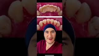 Pacientes se enojan después de una limpieza dental profunda. #shorts