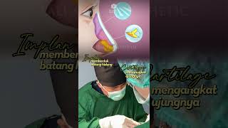 Download lagu Hidung Mancung dengan Instan | Rhinoplasty - La Lumiere Aesthetic mp3
