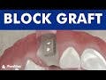 Block bone graft for dental implant ©