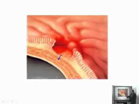 SDA dans le traitement de la fraction dhypertension Lhypertension, cardiaque ventriculaire gauche vidéo