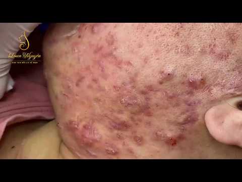 image-What are the grades of acne?