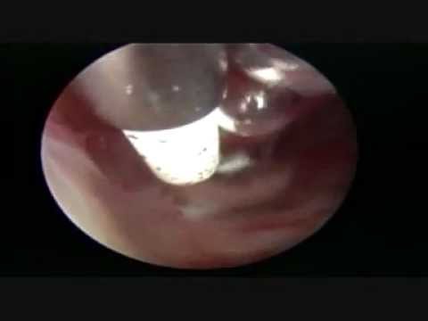 Osteocondrosi da Louise Hay Preparazione di joint coreana