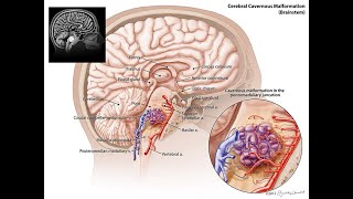 Download Lagu Brain stem ( Medullary) Cavernoma exision- Prof Velho Thumbnail