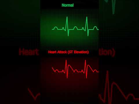 ECG Normal vs Heart Attack ST Elevation  How to Read ECG in Simple Steps! #HeartHealth #ECGInterpret