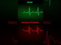 ECG Normal vs Heart Attack ST Elevation  How to Read ECG in Simple Steps! #HeartHealth #ECGInterpret