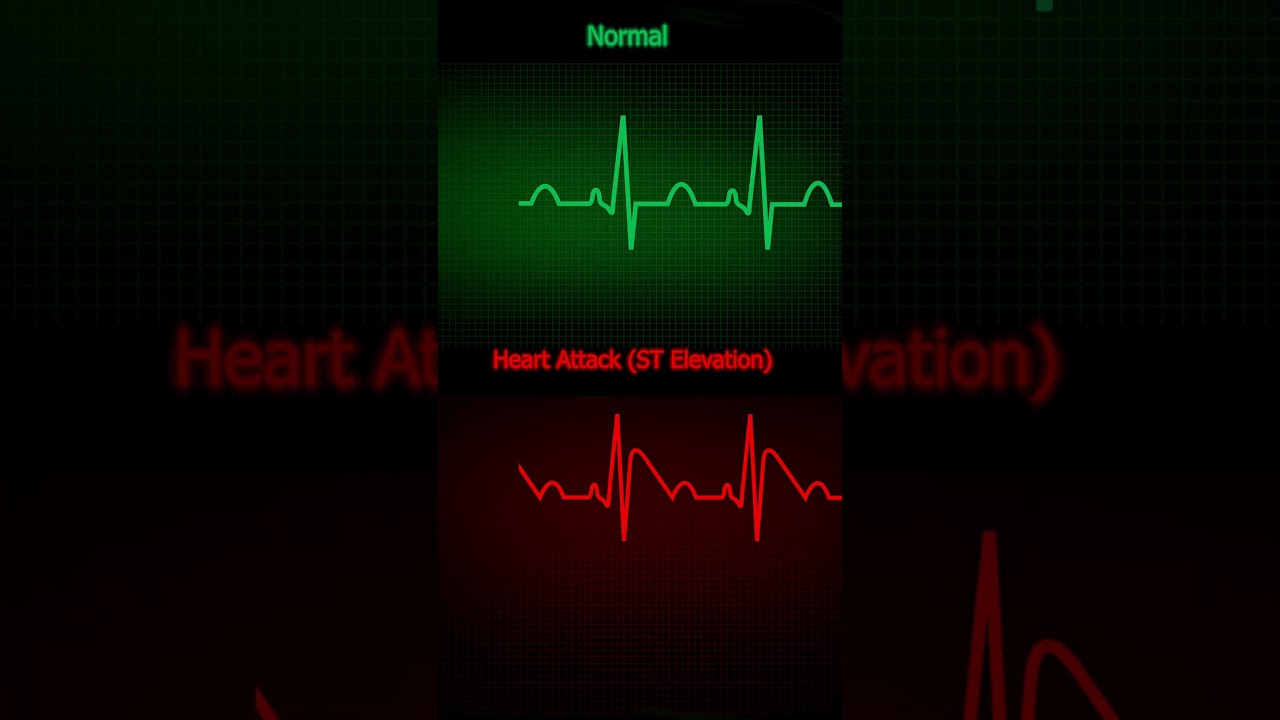 ECG Normal vs Heart Attack ST Elevation  How to Read ECG in Simple Steps! #HeartHealth #ECGInterpret