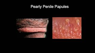 Doctor explains PEARLY PENILE PAPULES - small lumps on the head of the penis...