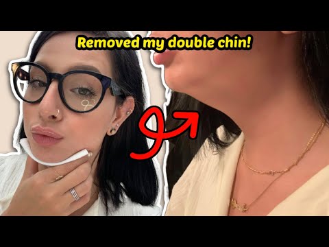 KYBELLA Double Chin Removal