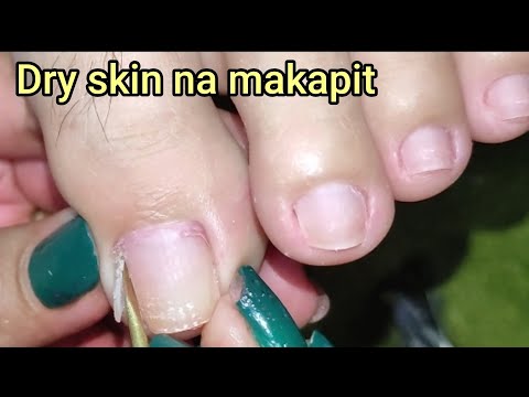 Vlog 174|Dry Skin/Ingrown Removal| PEDICURE 79