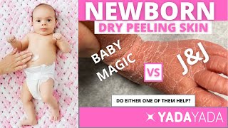 Will anything help my newborns dry skin?