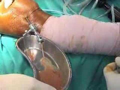 Arthroscopic Knee Cleanup  In Septic Inflammation